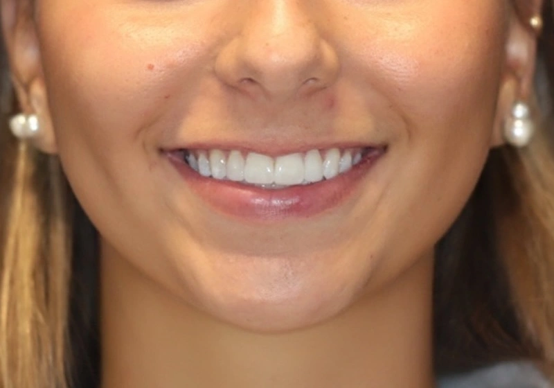 miel dental aesthetics after