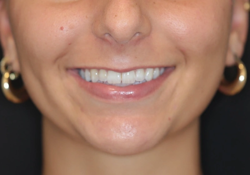 miel dental aesthetics before