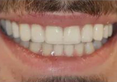 after Teeth