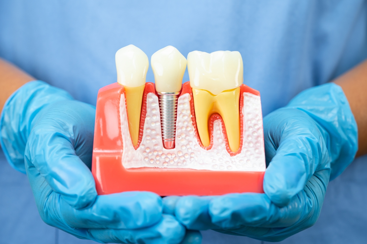 Dental Implant Repair Peabody