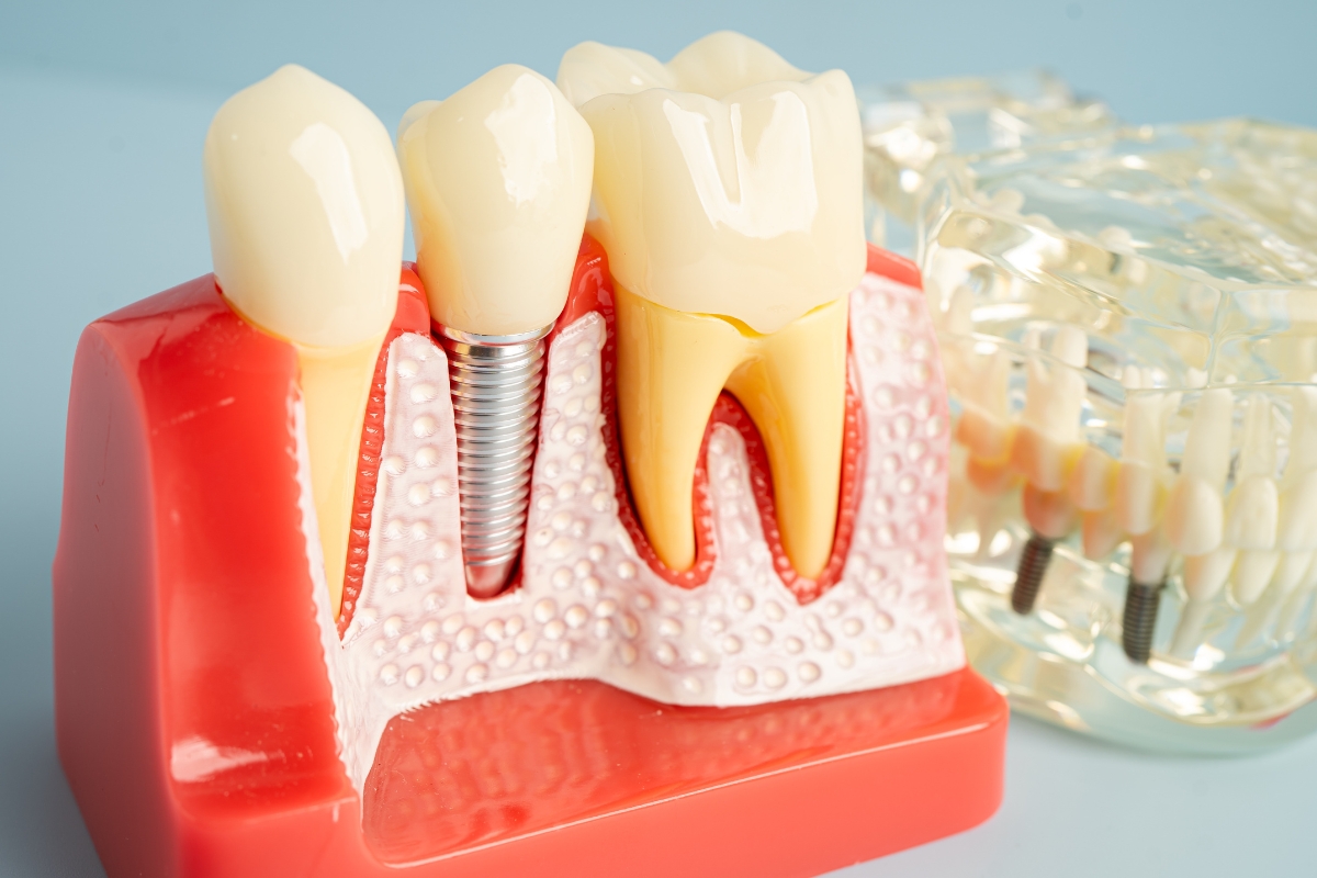 Dental Implant Repair Peabody
