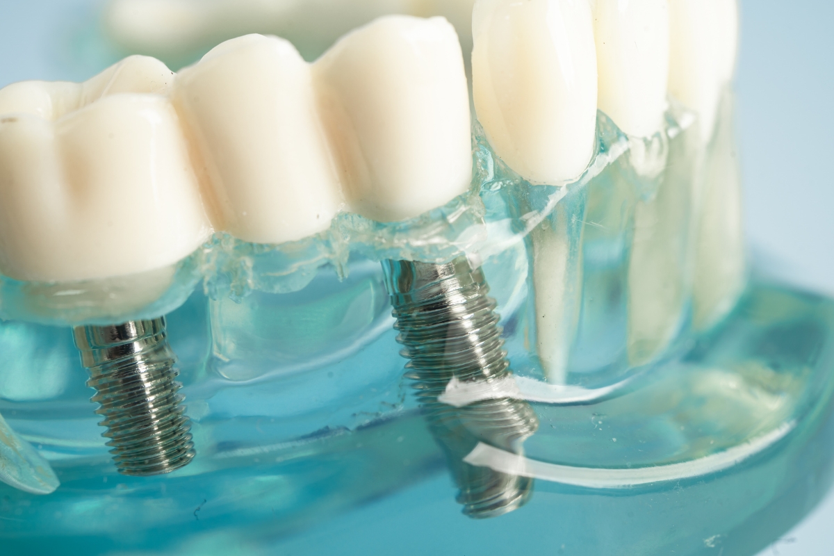 Dental Implant Repair Peabody