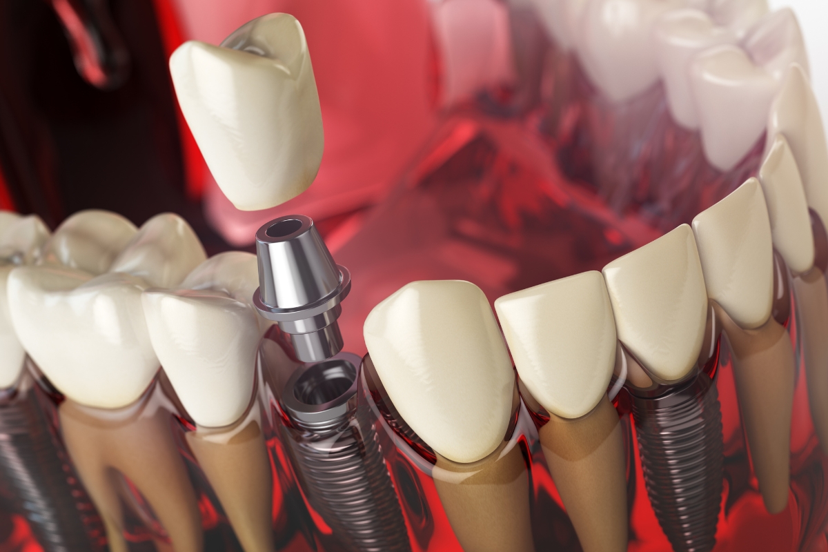 Dental Implant Repair Peabody