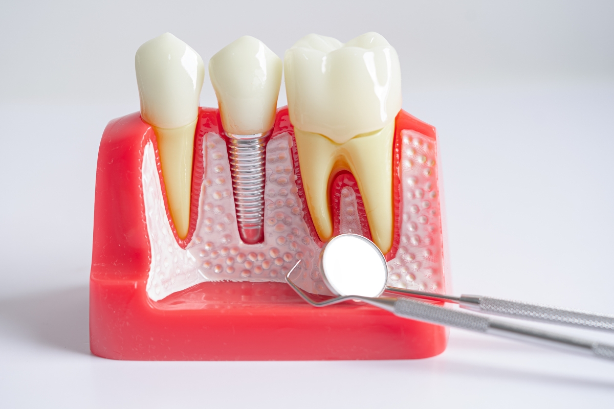 Dental Implant Repair Peabody