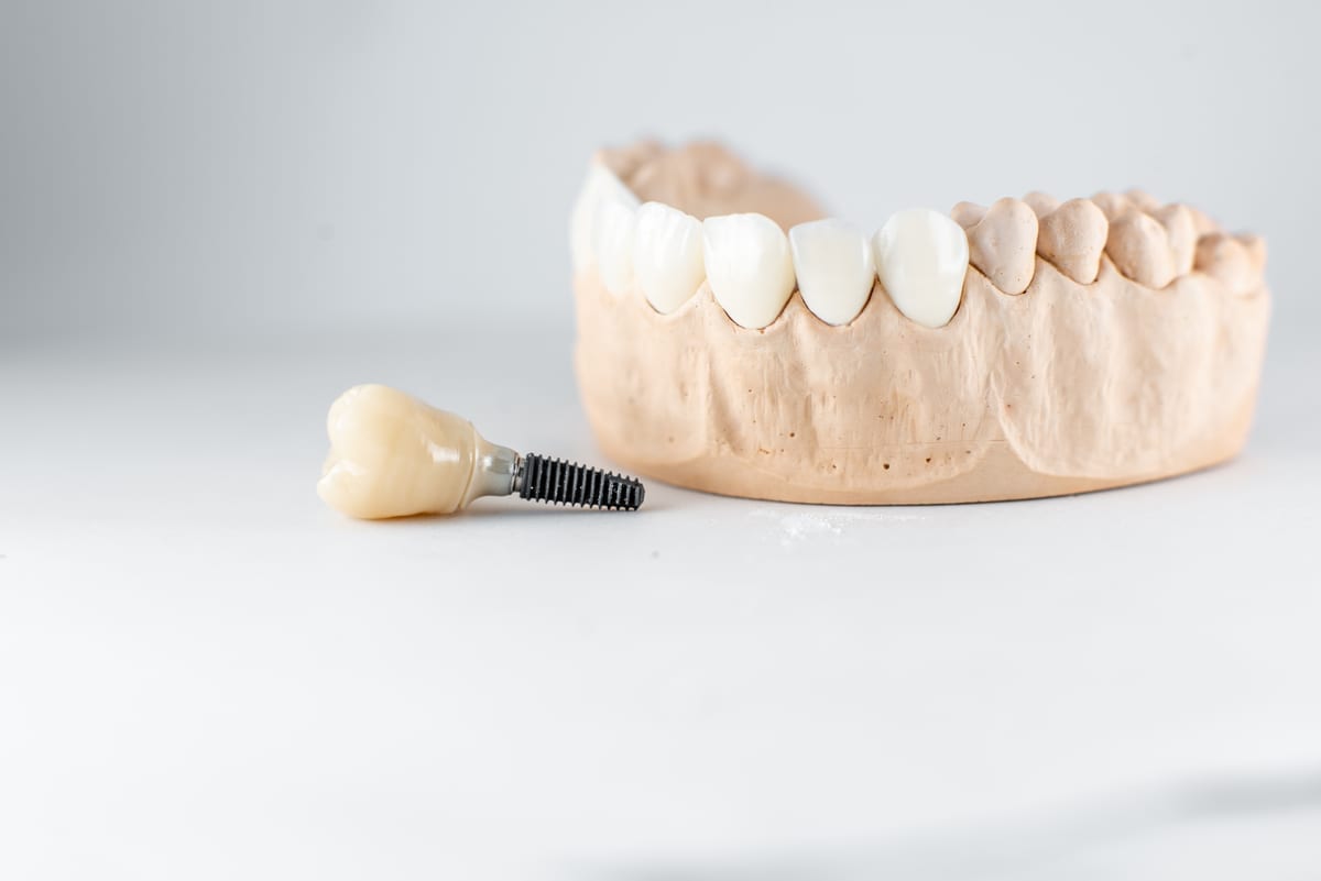 Dental Implants in Peabody